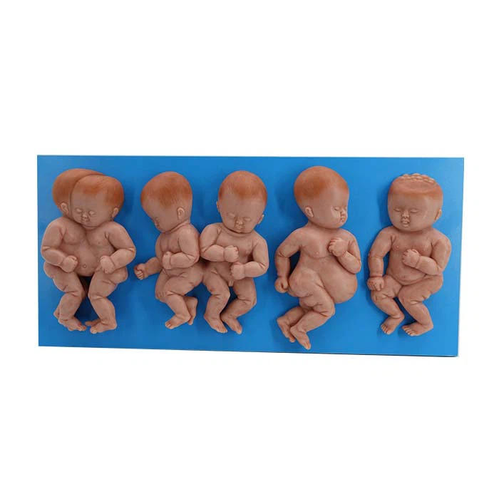 Simulation Deformed Fetus Silicone Model